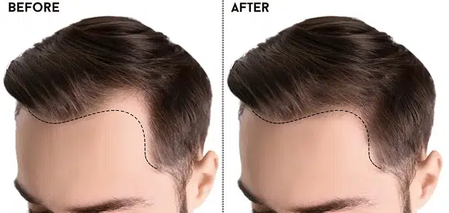 فوائد وأضرار زراعة الشعر