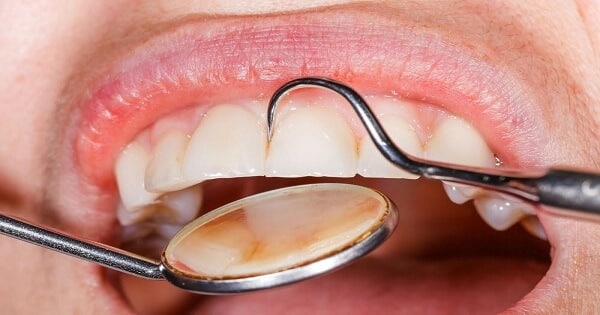 كيفية تقوية مينا الأسنان وعلاج التآكل
