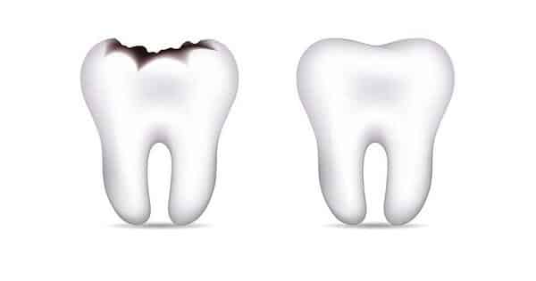مراحل تسوس الاسنان عند الاطفال بالتفصيل