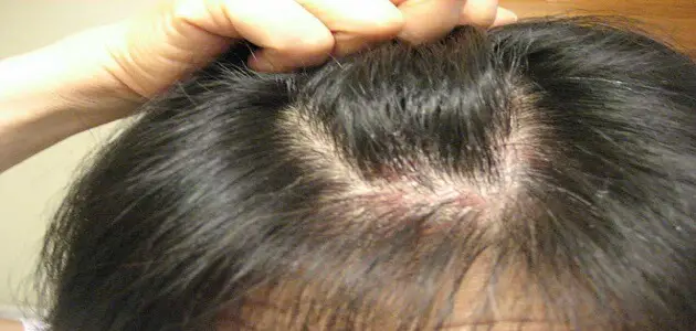 اسباب التهاب فروة الرأس والحكة وتساقط الشعر بالصور