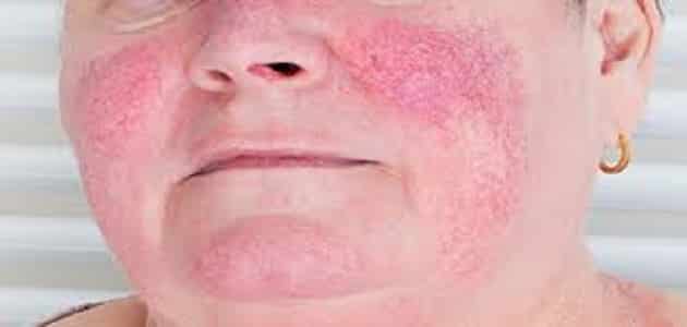 علاج النخالة الوردية المعكوسة وطرق تفادي العدوى منها