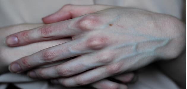 معلومات عن لماذا تظهر عروق اليد بشكل بارز عبر مرور السنوات