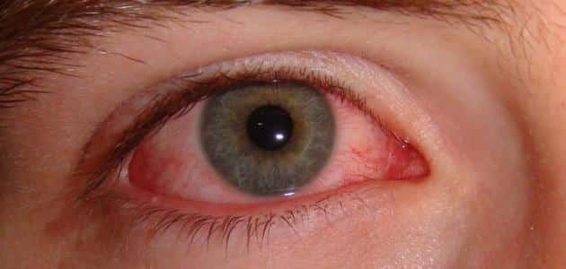 أسباب ألم العين عند تحريكها وعلاجها