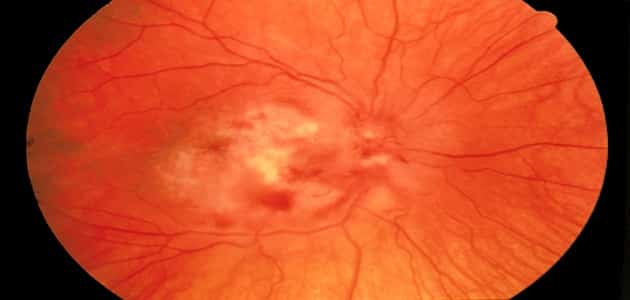 اعراض التهاب العصب البصري ومخاطر علاجه بالكورتيزون