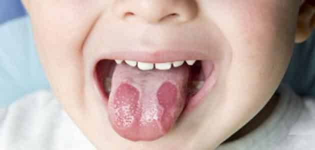علاج فطريات الفم والاسنان باستخدام دكتارين جل