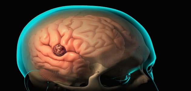 ما نسبة شفاء ونجاح عملية خراج المخ وأعراضه