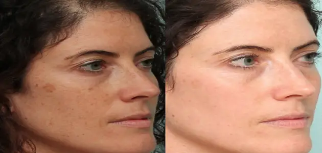 اسهل طريقة لازالة البقع السوداء في الوجه