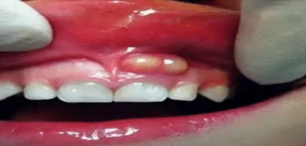 اسباب خراج الاسنان المتكرر