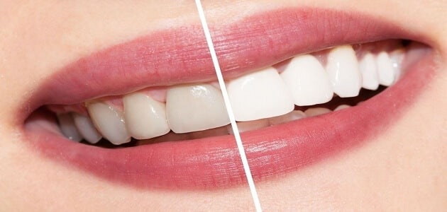 كيفية التخلص من صفار الأسنان