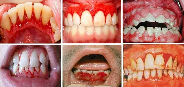 ما سبب خروج الدم من الفم