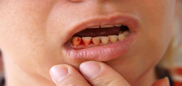 ما علاج نزيف اللثة عند تنظيف الأسنان