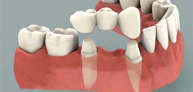 ما هو الجسر بين الأسنان