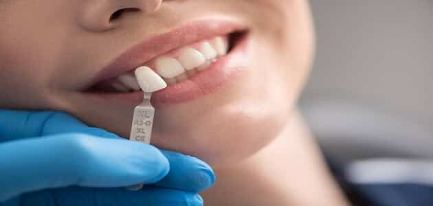 ما هي اضرار تلبيس الأسنان