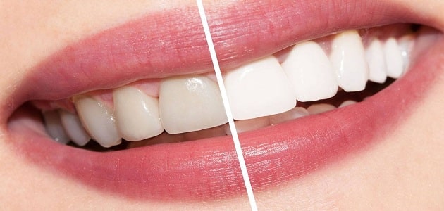 طرق بسيطة وسهلة لتبييض الأسنان