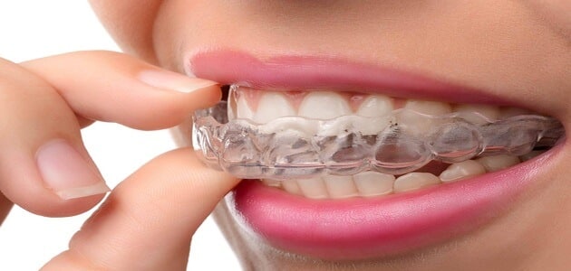 عيوب تقويم الاسنان الشفاف