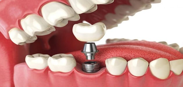 كيفية تركيب الاسنان الثابته