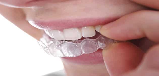 ما هو تقويم الاسنان وانواعه