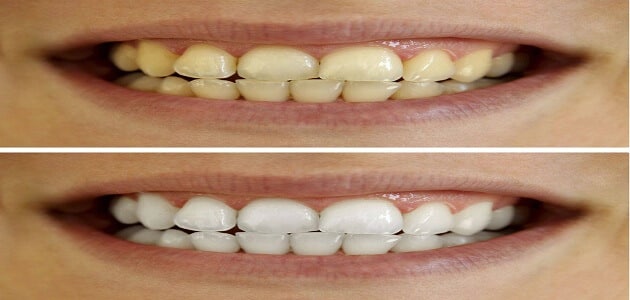 ما هي أسباب اصفرار الأسنان