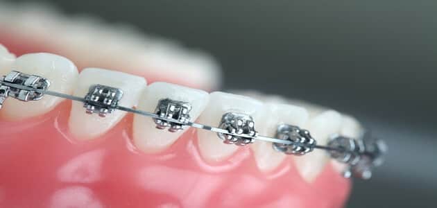 مراحل عملية تقويم الأسنان