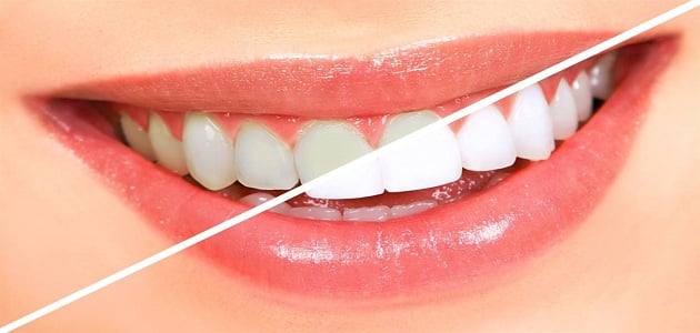 وصفات بيكربونات الصوديوم لتبييض الاسنان