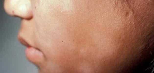 علاج الفطريات في الوجه والجسم