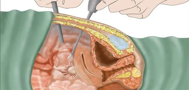 ما هي أعراض الألياف في الرحم ؟