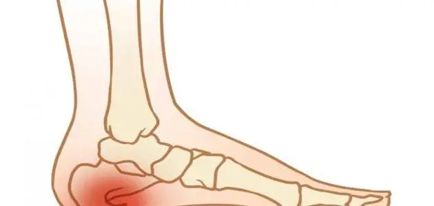 طرق علاج شوكة القدم