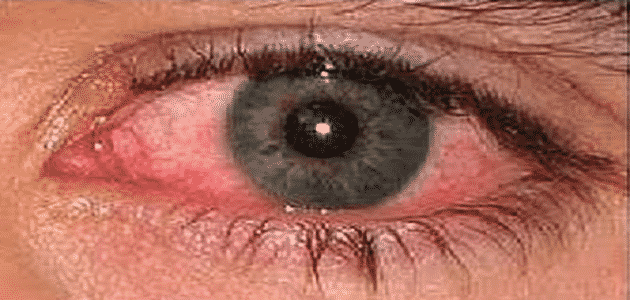 ما هو علاج حساسية العين
