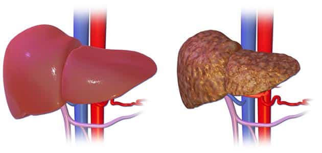 ما الفرق بين تشمع الكبد وتليف الكبد