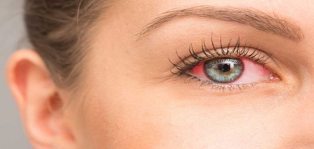 أسباب احمرار العين وكيفية علاجها