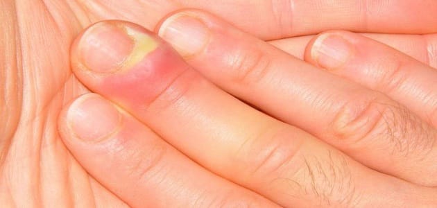 ما هو المرض الذي يصيب طرف الاصبع