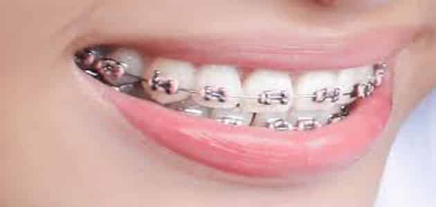 تقويم الاسنان | مميزاته وعيوبه | معلومات هامة