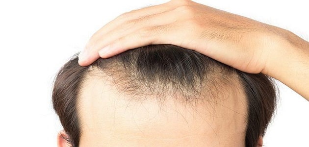 زراعة الشعر في السعودية | تكلفة العملية وكل ما يتعلق بها