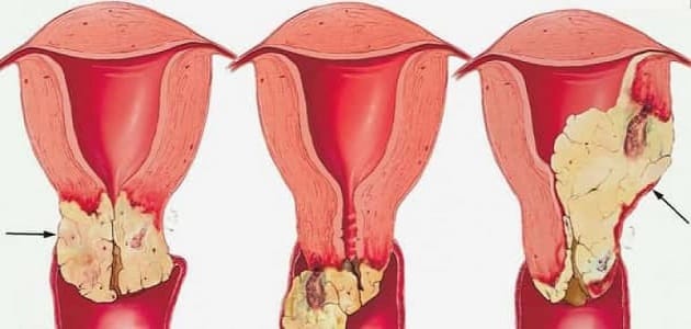 ما هي مسببات سرطان عنق الرحم