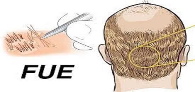 معلومات عن زراعة الشعر بالاقتطاف FUE وطريقة إجرائها