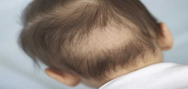 أسباب تساقط الشعر عند الأطفال وعلاجه