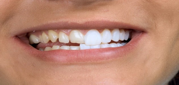 تلبيس الاسنان | أفضل الأنواع وطرق العلاج
