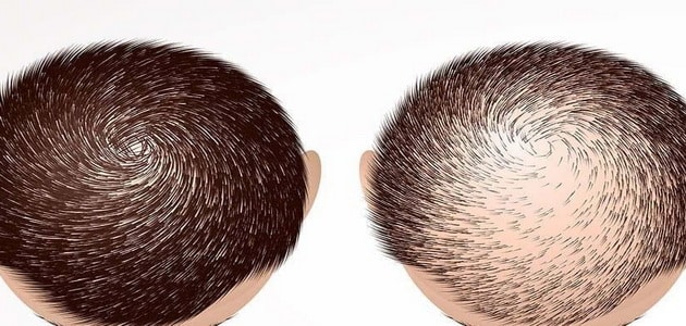 عملية زراعة الشعر في جدة | الأسعار والعيادات