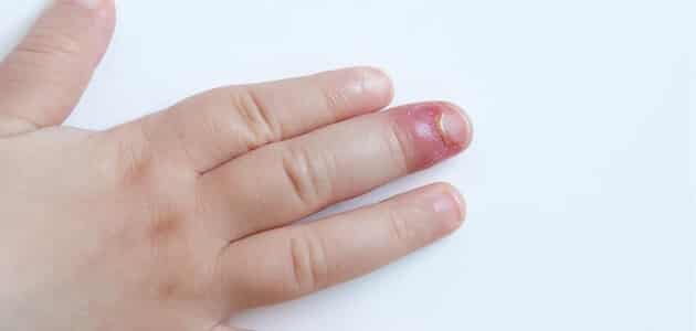 علاج الاصبع المدوحس بالادوية بالتفصيل