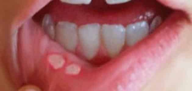 علاج تقرحات الفم واللثة الطحينة