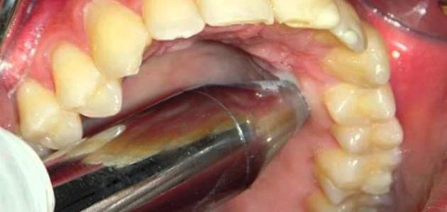 علاج خراج الاسنان المزمن بالمضاد الحيوي