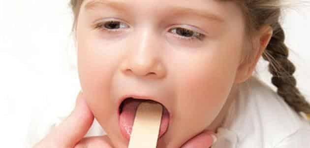مدة التهاب الحلق عند الأطفال