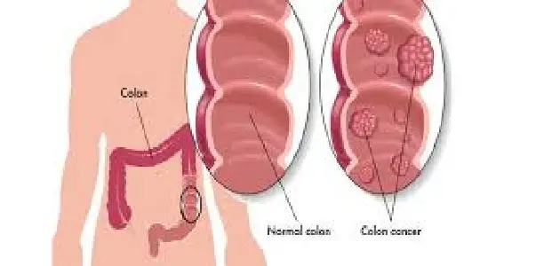 سرطان القولون ومراحله