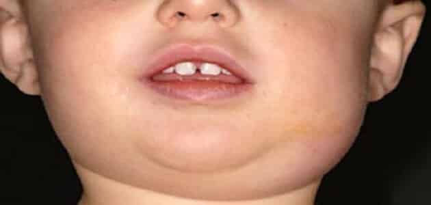 انتفاخ الغدد اللعابية تحت الفك السفلي عند الاطفال