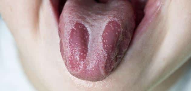 هل فطريات الفم خطيره وطرق علاجها