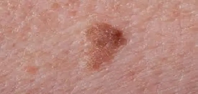 سرطان الجلد واعراضه