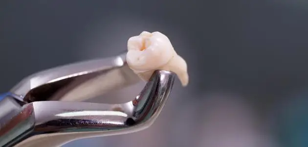 تفسير حلم سقوط الأسنان لابن سيرين