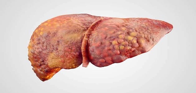 أعراض تليف الكبد المبكر وكيفية علاجه؟