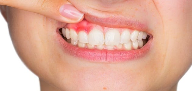 علاج خراج الأسنان بالمره