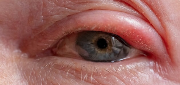ما هي اسباب انتفاخ العين وعلاجها ؟